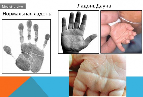 Генетика: Наследственно-дегенеративные заболевания нервной системы