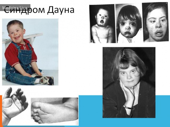 Генетика: Наследственно-дегенеративные заболевания нервной системы