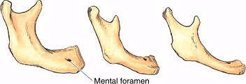 Анатомия: Переломы нижней челюсти (os mandibula)