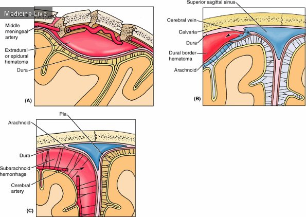 Травматология и ортопедия: Внутричерепные кровоизлияния