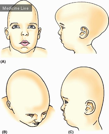 Педиатрия: Скафоцефалия, плагиоцефалия, и оксицефалия.