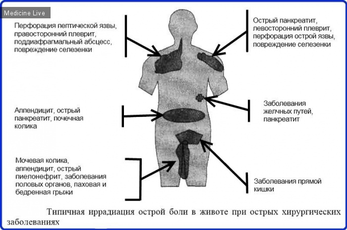 Хирургия: Иррадиация боли при хирургических заболеваниях