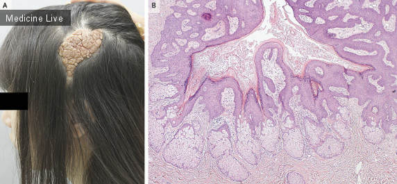 Интересный случай: Мозговидный невус сальных желез