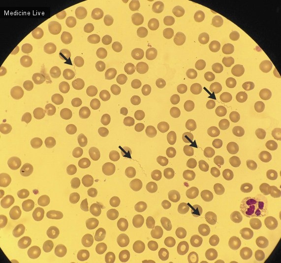 Все обо всем: Инфекция Borrelia Recurrenris