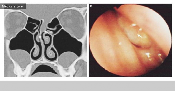 Интересный случай: Выделение из левой носовой полости