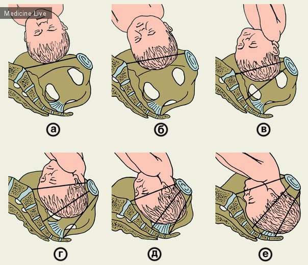 Акушерство и гинекология: Положение головки плода по отношению к плоскостям малого таза