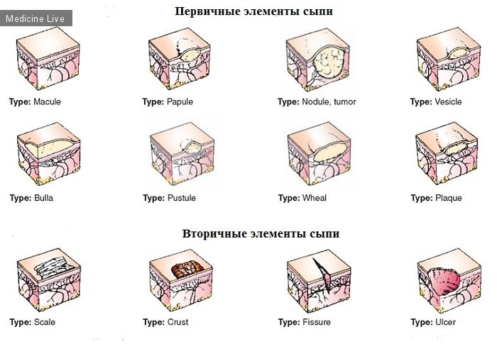Дерматовенерология: Первичные морфологические элементы