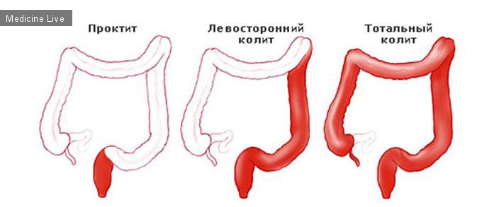 Хирургия - лекция 5 - Заболевания кишечника