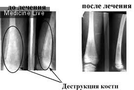 Хирургия - лекция 14 - Остеомиелит