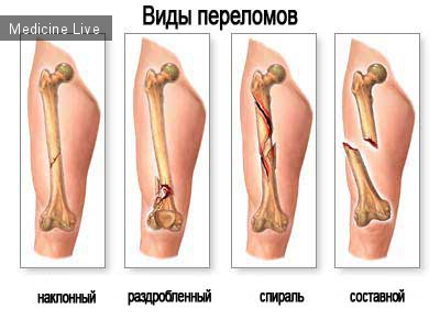 Хирургия: Переломы костей