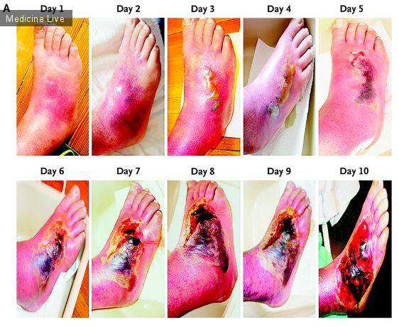 Интересный случай: Медицинские истории: Развитие воспаления стопы при диабете