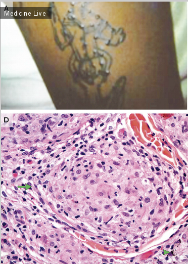 Интересный случай: Татуировки и саркоидоз - еще один повод не делать татуировку