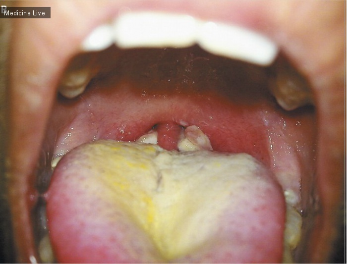 Интересный случай: Дифтерия ротоглотки