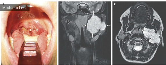 Интересный случай: Асимметрия миндалин вследствие опухоли околоушной железы