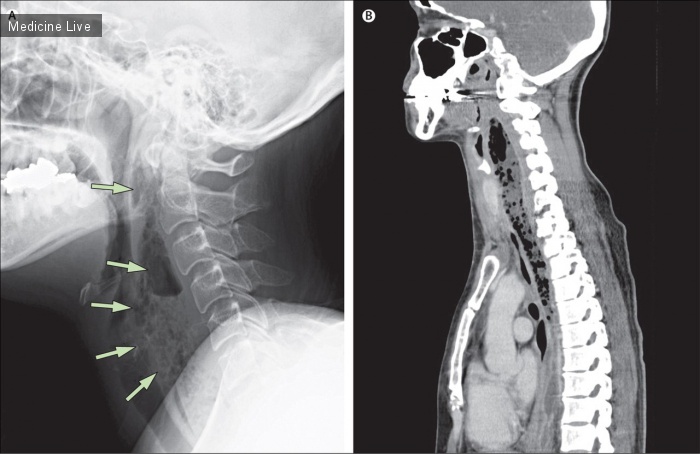 Интересный случай: Эмфизема заглоточного пространства у пациентки с нисходящим некротизирующим медиастинитом