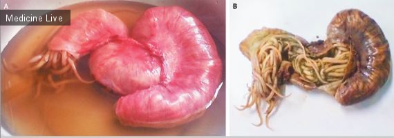 Интересный случай: Обструктивный аскаридоз подвздошной кишки