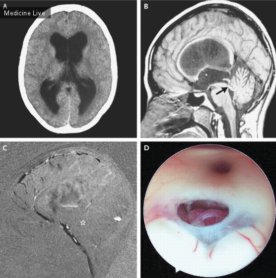Интересный случай: Идиопатический стеноз водопровода мозга