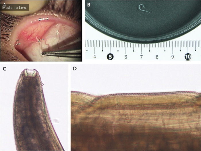 Интересный случай: Черви в глазу