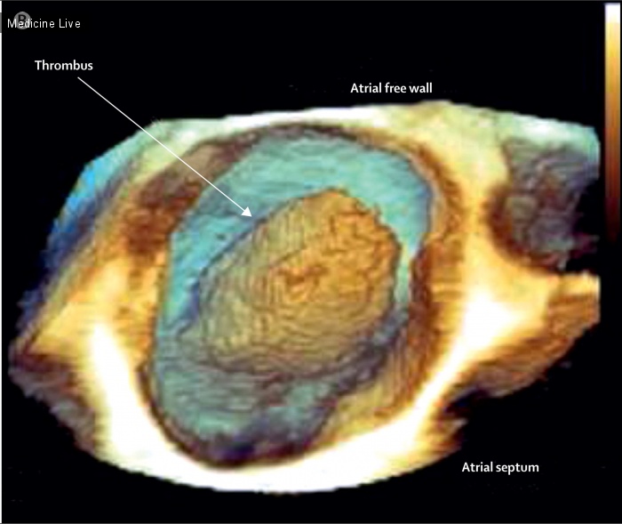 Интересный случай: Подвижное образование в полости левого предсердия
