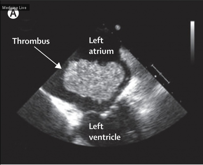 Интересный случай: Подвижное образование в полости левого предсердия