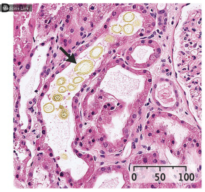 Интересный случай: Острая кристаллическая нефропатия, вызванная приемом метотрексата