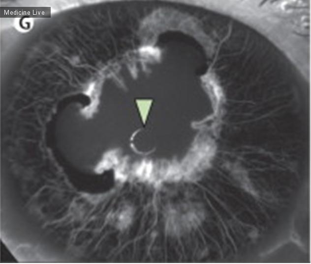 Интересный случай: Неоваскуляризация радужки на фоне диабетической ретинопатии, регрессировавшая на фоне лечения субконъюнктивальными анти-VEGF инъекциями