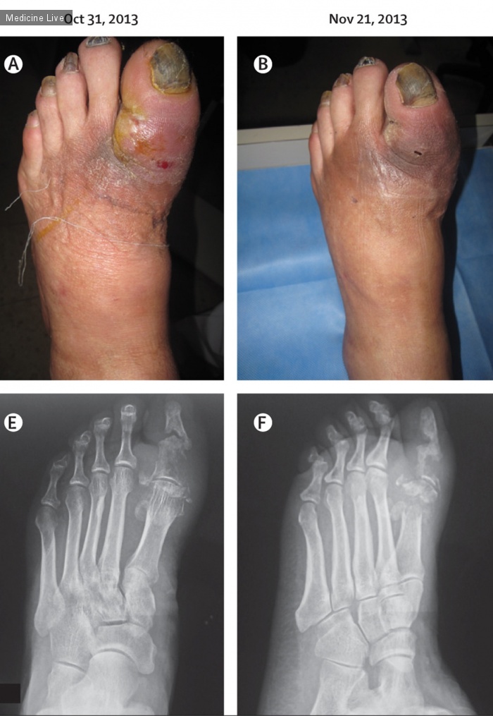 Интересный случай: Остеомиелит на диабетической стопе, регрессировавший при консервативном лечении