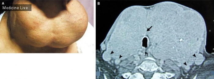 Интересный случай: Эндемический многоузловой зоб