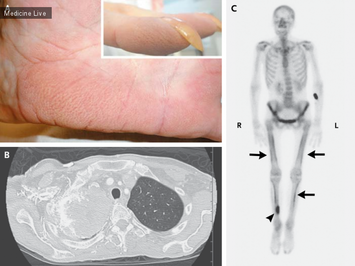 Интересный случай: Гипертрофическая легочная остеоартропатия и пальмарное рубцевание