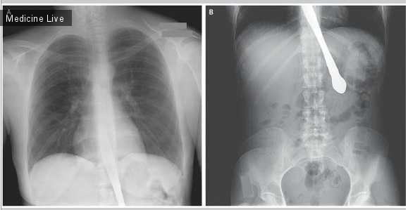 Интересный случай: Инородное тела пищевода и желудка или неожиданное проглатывание ножа.