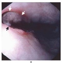 Интересный случай: Язвы  пищевода