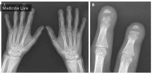 Интересный случай: Акроостеолиз с полосной деструкцией фаланг пальцев рук