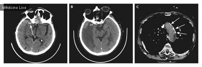 Интересный случай: Атеросклеротические изменения  аорты как вероятный источник церебральной эмболии