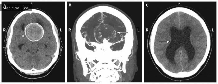 Интересный случай: Гигантская  внутричерепная аневризма