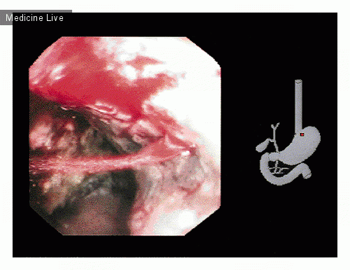Интересный случай: Острое кровотечение при язве желудка