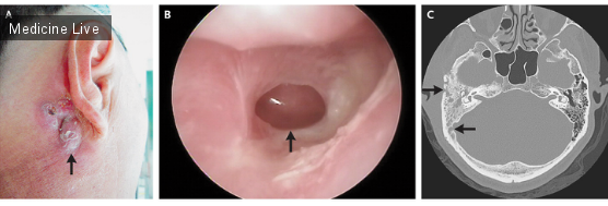 Интересный случай: Мастоидит