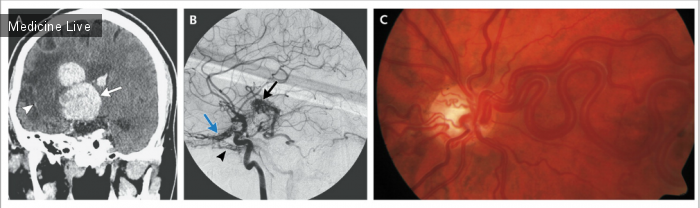 Интересный случай: Внутримозговая артериовенозная мальформация