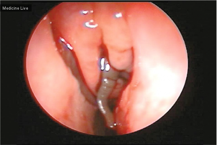 Интересный случай: Одностороннее носовое кровотечение / Unilateral Epistaxis