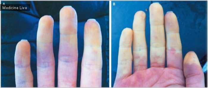Интересный случай: Изменение цвета после воздействия холода при болезни Рейно
