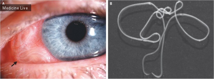 Интересный случай: Субконъюктивальный Dirofilaria repens