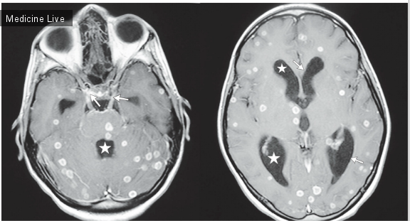 Интересный случай: Множественные интракраниальные туберкуломы
