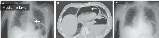 Интересный случай: Пневмоперикард ассоциированный с пептической язвой