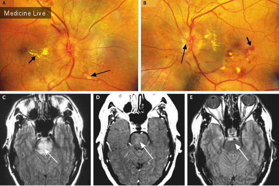 Интересный случай: Изменения в стволе головного мозга и глазном дне при злокачественной гипертензии