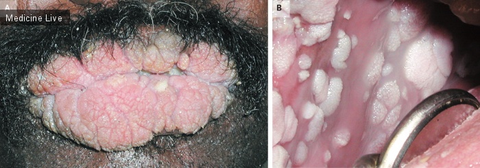 Интересный случай: Папилломатоз ротовой полости