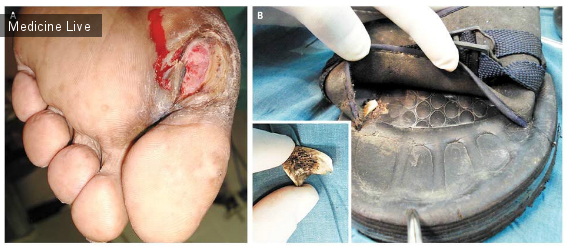Интересный случай: Нейропатическая язва