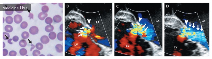Интересный случай: Кардиология: Гемолитическая анемия после замены митрального клапана