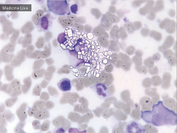 Интересный случай: Цистиновые кристаллы в костном мозге