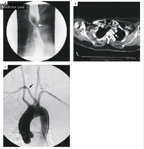 Интересный случай: Аберрантная правая подключичная артерия и дисфагия лузория