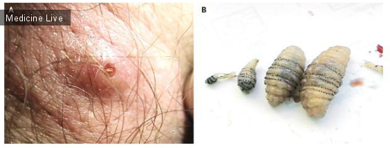 Интересный случай: Дерматобиаз при поражении личинками Dermatobia hominis(«Myiasis Due to Dermatobia hominis (Human Botfly)»)