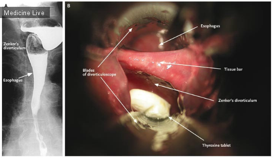 Интересный случай: Дивертикул Ценкера